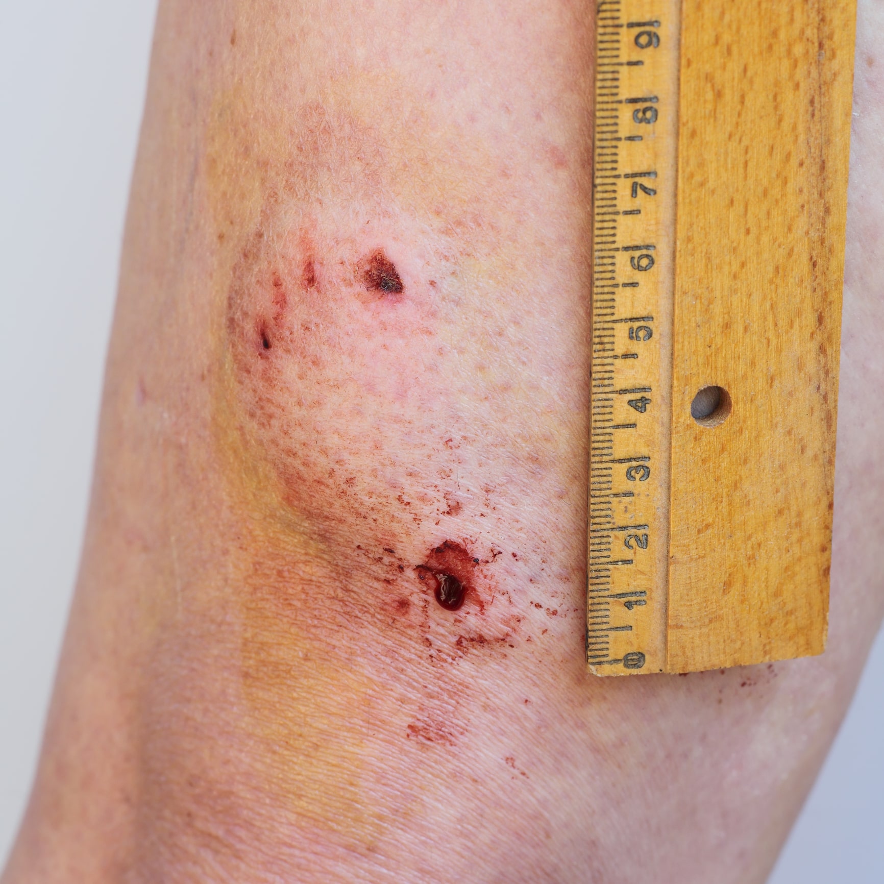Person's arm showing dog bite puncture wound and ruler measuring size of wounded area