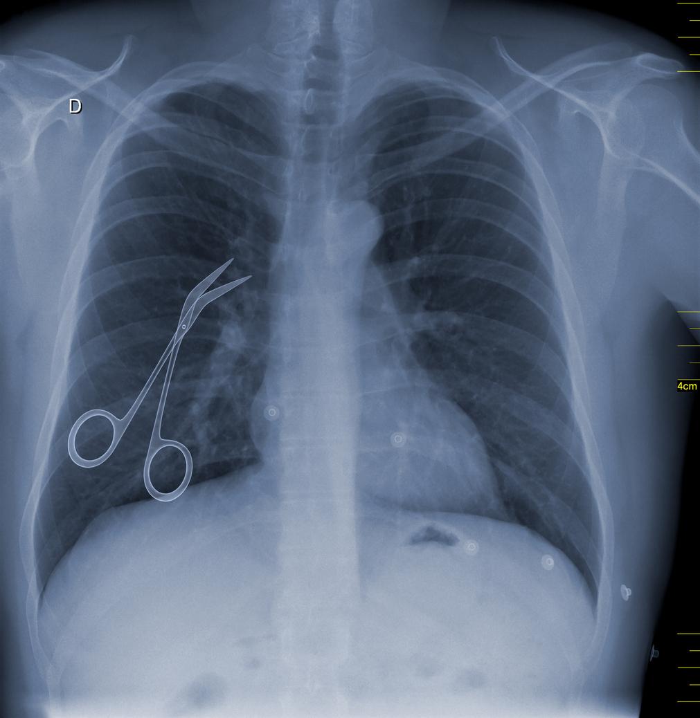 X-ray showing surgical instrument accidentally left inside body